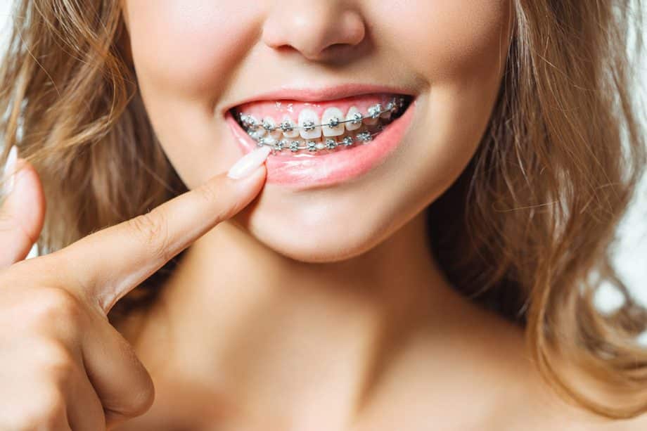 10 Foods To Avoid With Braces