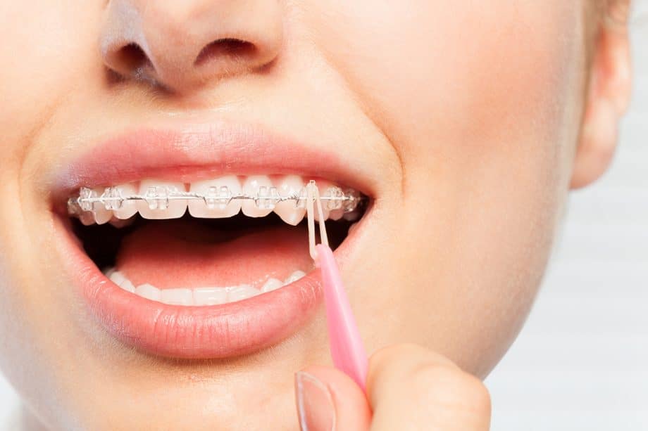 Adult Braces: Are They Right for You?