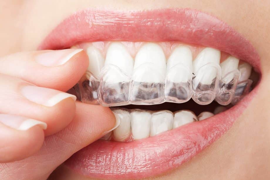 Could I Be a Candidate for Invisalign?